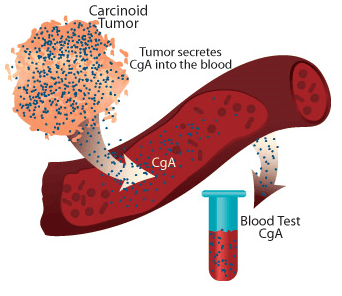 carcinoide tumore neuroendocrino